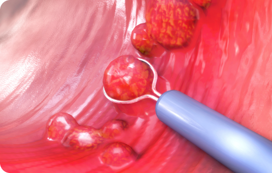 당일 용종절제술